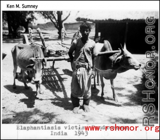Man with elephantiasis in Pandaveshwar, India, during WWII, 1943.